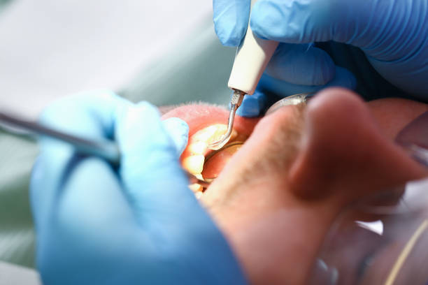 Best Emergency Treatment for Dental Infections or Abscesses in Terryville, CT